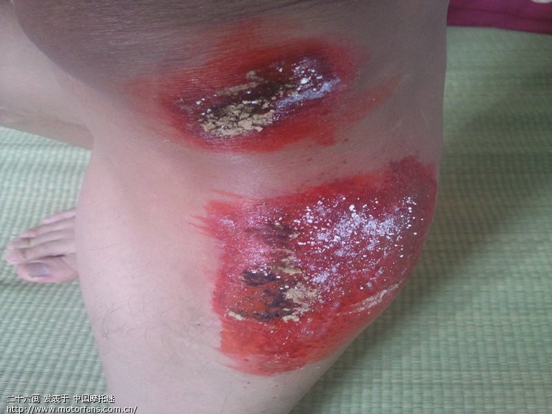 夏天的伤痕,都是技术不佳惹的祸 - 安徽摩友交